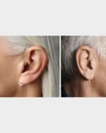 Set de 2 aides auditives